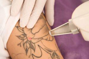 what is tattoo removal